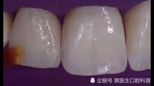 齲怎么讀,齲的拼音